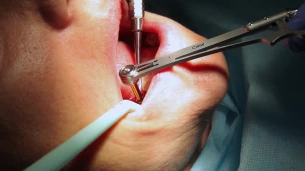 Tandheelkundige implantatie operatie aan een patiënt op het tandheelkunde kantoor. Plaatsing van tandheelkundige implantaten in echte goed. — Stockvideo