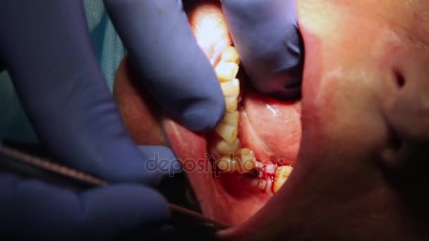 Dentista che cura i denti di un paziente con strumenti dentali in una clinica dentistica. Protesi dentarie, protesi dentarie, protesi. Filmati editoriali . — Video Stock