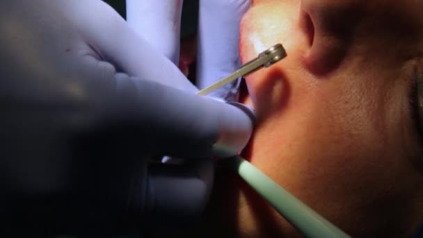 Cirugía de implantación dental en un paciente en el consultorio de odontología. Colocación de implantes dentales en paciente real . — Vídeos de Stock