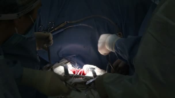 Heart Surgery Works Urgery — Stock Video