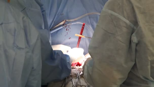 Хірургія Серця Працює Хірургії — стокове відео