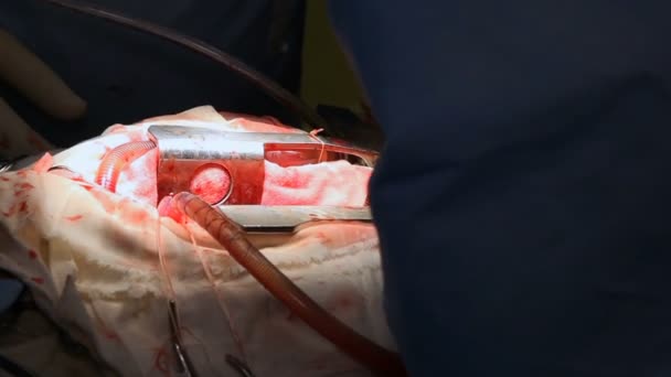 Chirurgie Cardiaque Travaux Chirurgie — Video