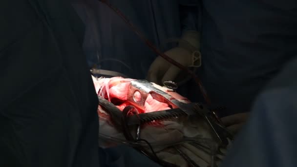 Cirurgia Cardíaca Trabalhos Cirurgia — Vídeo de Stock