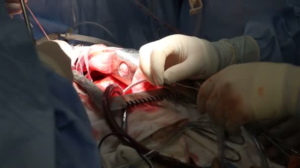 Cirurgia Cardíaca Trabalhos Cirurgia — Vídeo de Stock