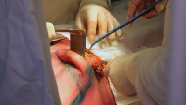 Onkoloji Meme Bezinin Habis Bir Tümör Çıkarılması Meme Implantı Yüklendikten — Stok video