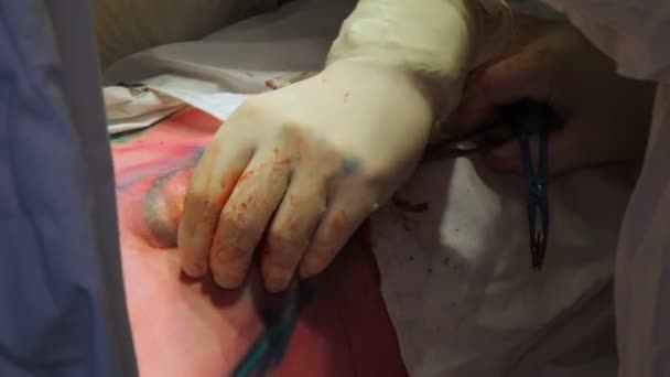 Oncologie Wegnemen Van Een Kwaadaardige Tumor Van Melkklier Installatie Van — Stockvideo