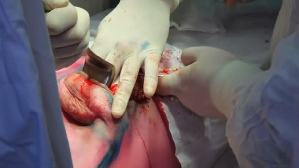 Onkologie Entfernung Eines Bösartigen Tumors Der Brustdrüse Einbau Eines Brustimplantats — Stockvideo