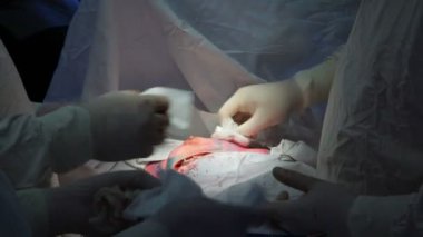 Onkoloji. Meme bezinin habis bir tümör çıkarılması. Meme implantı yüklendikten sonra bir kanserli tümör çıkarılması.