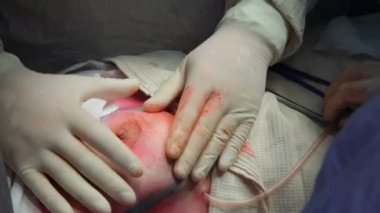 Onkoloji. Meme bezinin habis bir tümör çıkarılması. Meme implantı yüklendikten sonra bir kanserli tümör çıkarılması.