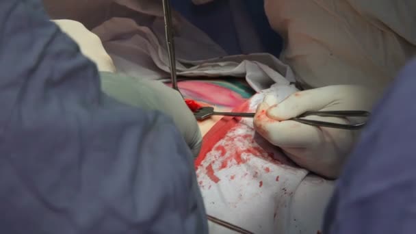Onkologi Borttagning Malign Tumör Bröstkörteln Installation Ett Bröstimplantat Efter Borttagning — Stockvideo