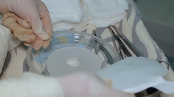 Εμφυτευμάτων Στήθους Αφαίρεσης Του Κακοήθους Όγκου Του Μαστικού Αδένα Εγκατάσταση — Αρχείο Βίντεο