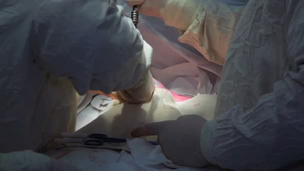 Oncologie Retrait Une Tumeur Maligne Glande Mammaire Installation Implant Mammaire — Video
