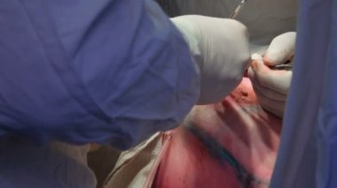 Onkoloji. Meme bezinin habis bir tümör çıkarılması. Meme implantı yüklendikten sonra bir kanserli tümör çıkarılması.