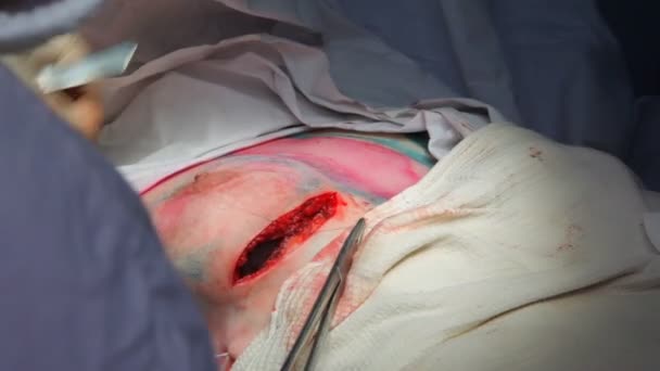 Onkologi Borttagning Malign Tumör Bröstkörteln Installation Ett Bröstimplantat Efter Borttagning — Stockvideo