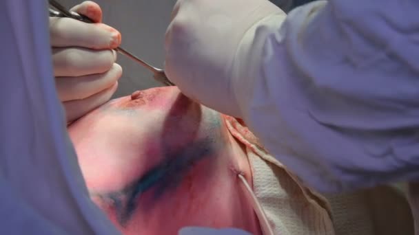 乳腺の悪性腫瘍の除去 乳房インプラントの癌性腫瘍を除去した後のインストール — ストック動画