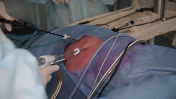 腎臓の悪性腫瘍の除去 腎臓の切除 腹腔鏡下の腹部操作中に外科医チーム手 — ストック動画