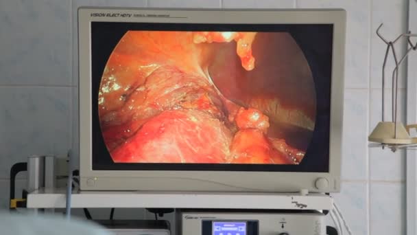 Vinnitsa 乌克兰 2018年4月10日 切除肾脏恶性肿瘤 肾切除术 腹腔镜腹部手术中的外科医生团队手 — 图库视频影像