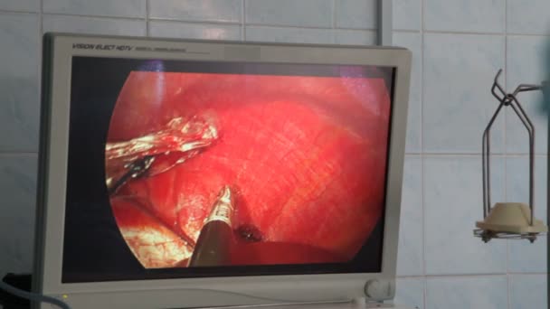 ビニツァ ウクライナ 2018 腎臓の悪性腫瘍の除去 腎臓の切除 腹腔鏡下の腹部操作中に外科医チーム手 — ストック動画