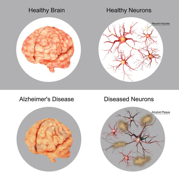 The patient and the brain healthy brain and neurons in compariso — Stock Photo, Image