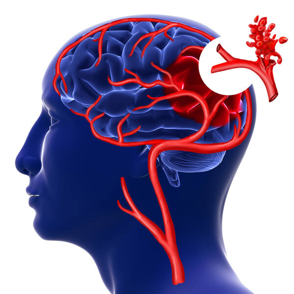 Brain hemorrhage. 3d rendering