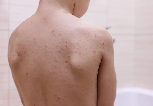 Child's back. Eczema atopic dermatitis symptom skin. Symptom. — Stock Photo, Image