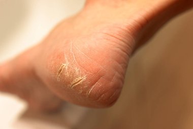 Topuklu ayakkabılar, beyaz kadın ayakları. Yakın plan. Pedikür, çok kuru cilt, vitamin eksikliği..
