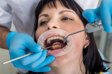 Diş hekimi hastanın dişlerini ayna kapağıyla inceliyor.