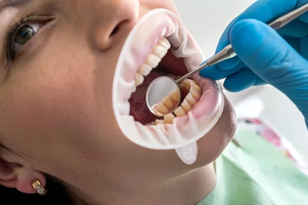 Μακρο Των Δοντιών Του Ασθενούς Τον Καθρέφτη Του Οδοντιάτρου — Φωτογραφία Αρχείου