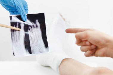 Doktor gösteren hastanın x-ray görüntü kırık bir parmak, beyaz kanepede yatan alçı bacak