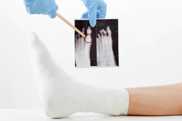 Lékař zkoumá rentgenového snímku, zlomenou nohou pacienta v sádře ležel na gauči — Stock fotografie