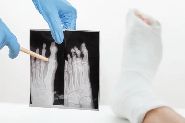 Doctor showing patient x-ray image of a broken finger,leg in plaster lying on the couch, on white