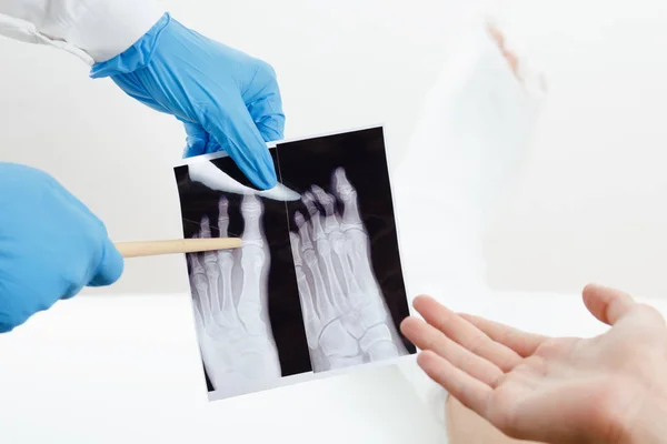 Doktor zobrazeno pacienta rentgenový snímek zlomený prst nohy v sádře — Stock fotografie