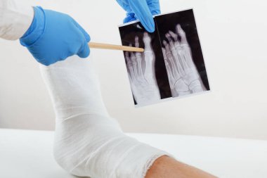 Doktor x-ray görüntü, kanepede yatan alçı içinde hastanın bacağı kırılmış inceliyor