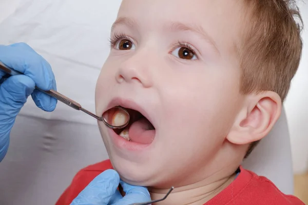 Медицинское обследование зубов ребенка с помощью зеркала стоматолога. Кариес, повреждения зубов . — стоковое фото