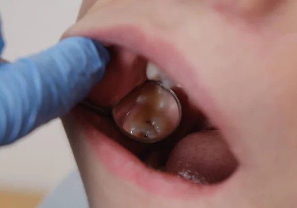 Медицинское обследование зубов с помощью зеркала стоматологом. Кариес, повреждения зубов . — стоковое фото