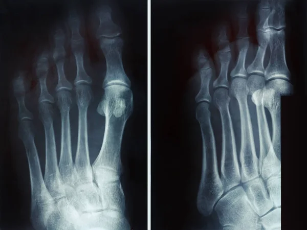 Fractura de rayos X de película falange proximal en el quinto dedo del pie — Foto de Stock