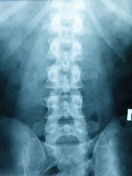 Rayos X Escoliosis película rayos X columna lumbar AP — Foto de Stock