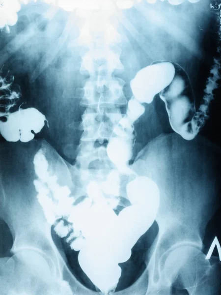 Imagen de rayos X abdomen liso, colon — Foto de Stock