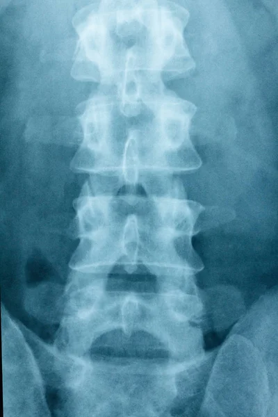 Rayos X Escoliosis película rayos X columna lumbar AP — Foto de Stock