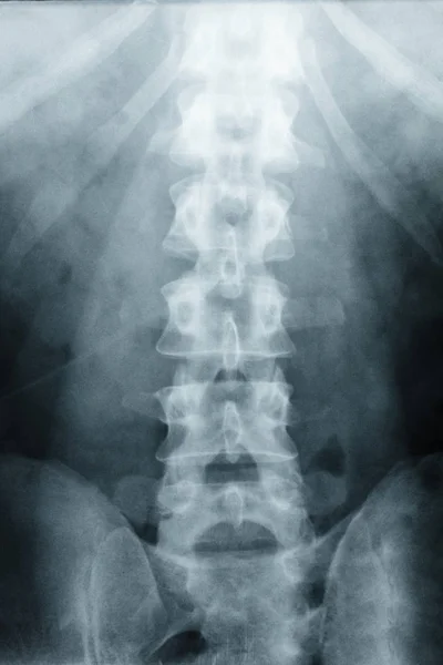 Rayos X Escoliosis película rayos X columna lumbar AP — Foto de Stock