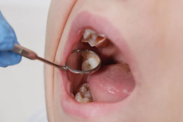 Exame médico da macro dentes usando um espelho por um dentista. Cáries, danos dentários . — Fotografia de Stock