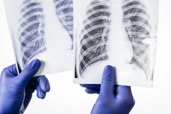 Radiographie Pulmonaire Covide Médecin Hôpital Coronavirus Ncov — Photo