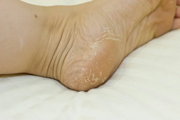 Cracked skin on heels. Foot Treatment.