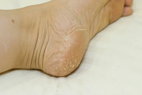 Cracked skin on heels. Foot Treatment. — Stock Photo, Image