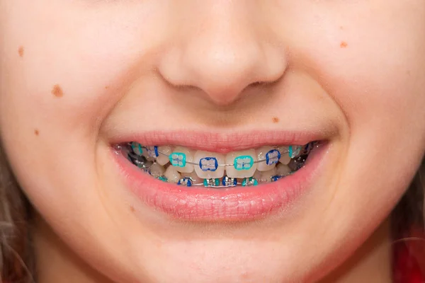 Stock photo of the metal braces — Stock Photo, Image