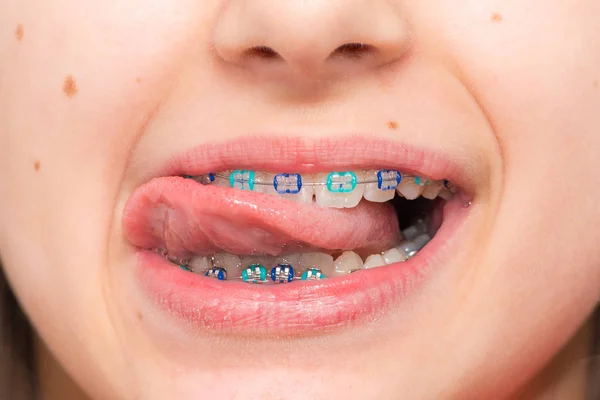 Stock photo of the metal braces