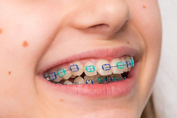 Stock photo of the metal braces — Stock Photo, Image