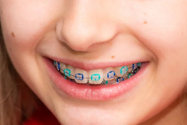 Stock photo of the metal braces