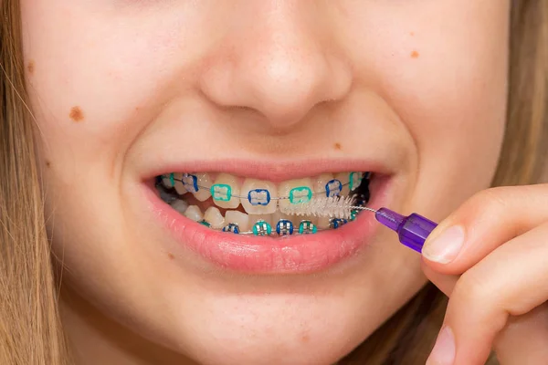 Metal diş telleri hazır fotoğraf Telifsiz Stok Imajlar