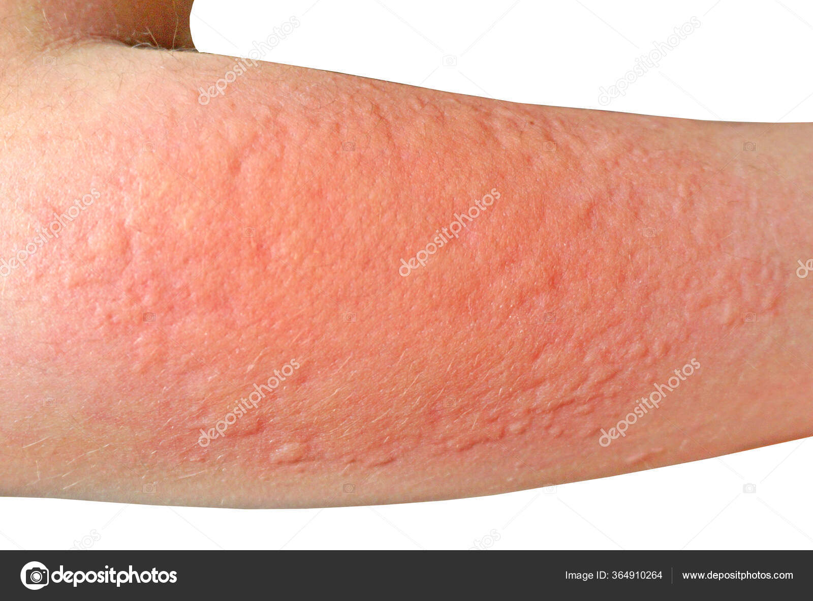 Skin Rashes Allergies Contact Dermatitis Allergic Chemicals Fungal